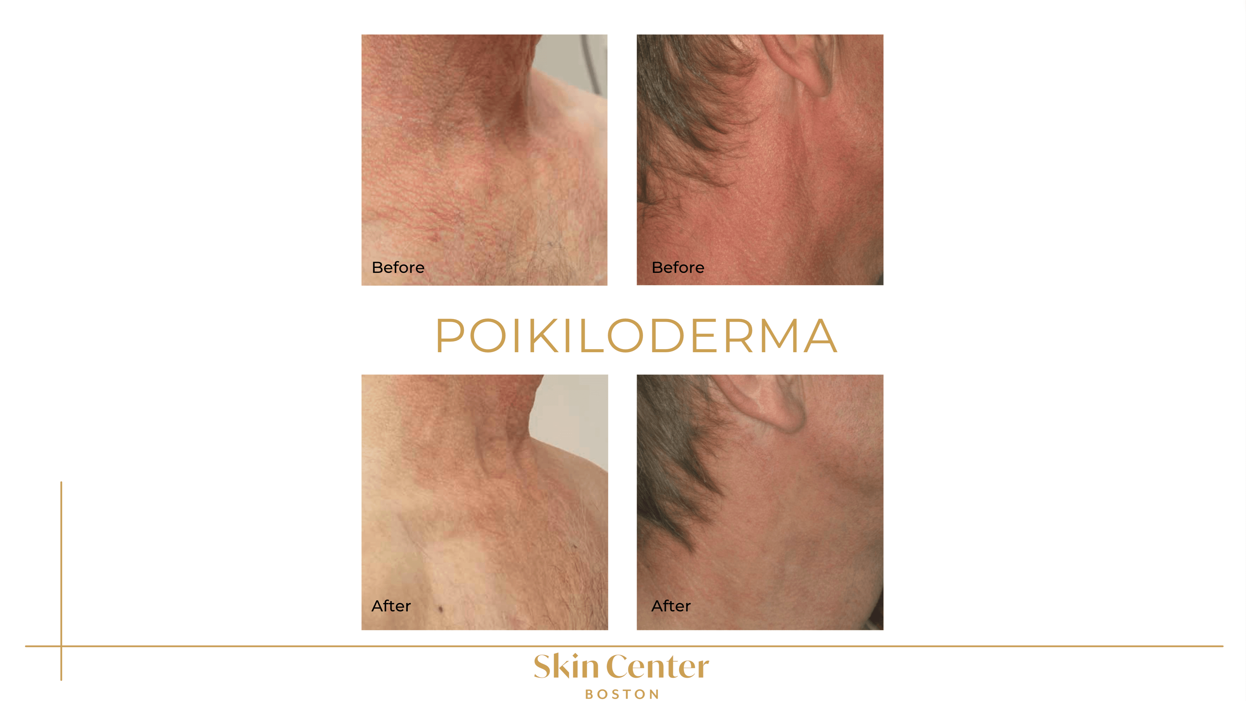IPL - Poikiloderma Before & Af